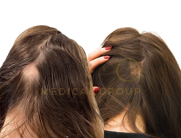 673dcd9ede064625d064d5fd_alopecia results-4