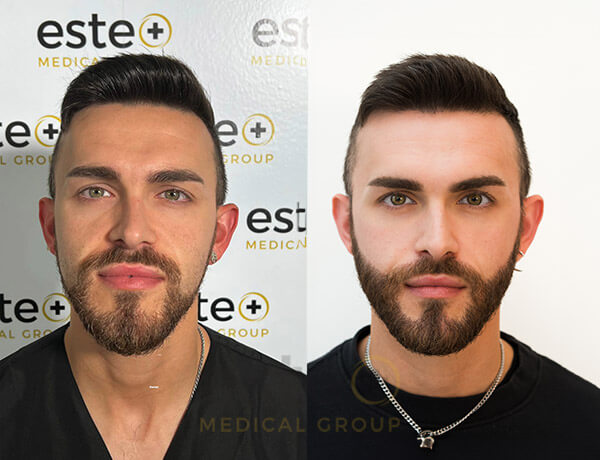 675828ddbfe1c863b8a536a6_Josh-Before-After