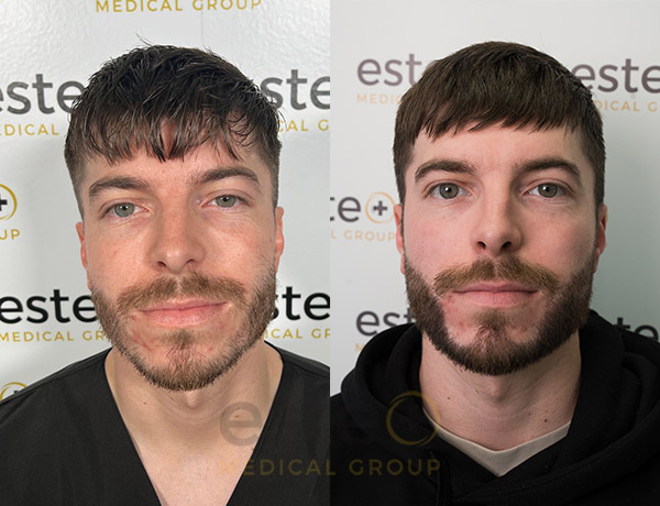 678a3e4585fb0a8f1fb742ac_Harry_-Before-after-1