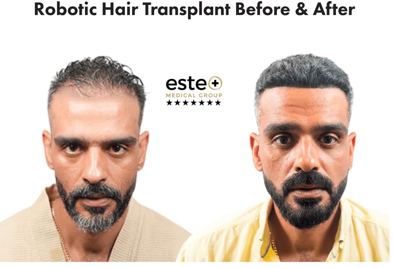 Dubai Robotic Hair Transplant